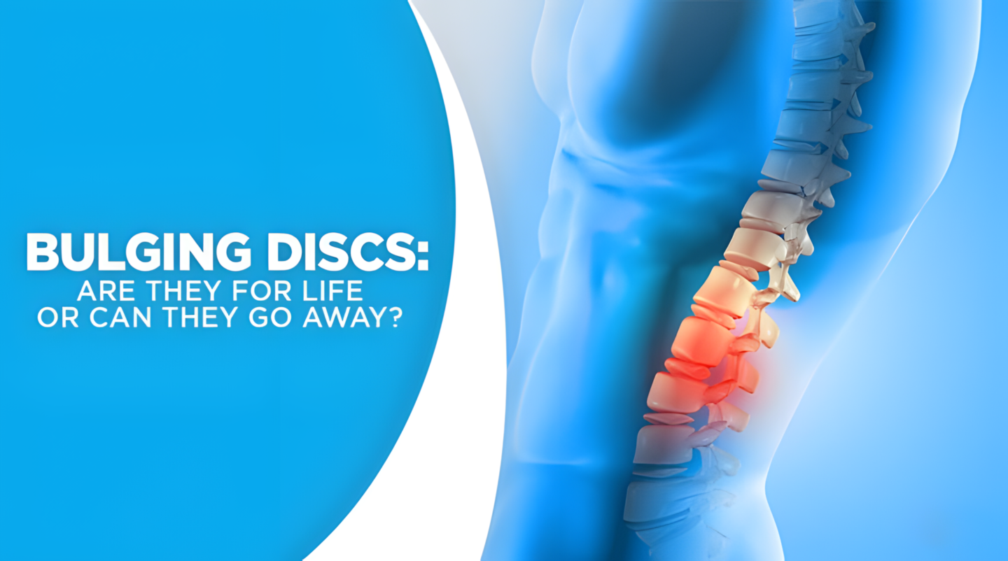 Bulging Discs: Are They For Life or Can They Go Away?