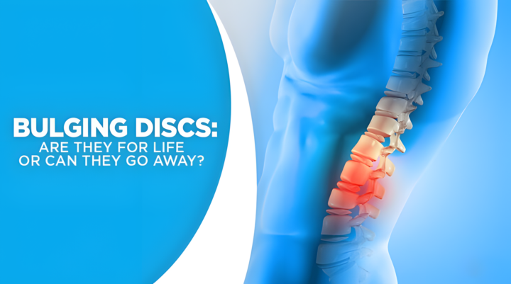 Bulging Discs: Are They For Life or Can They Go Away?