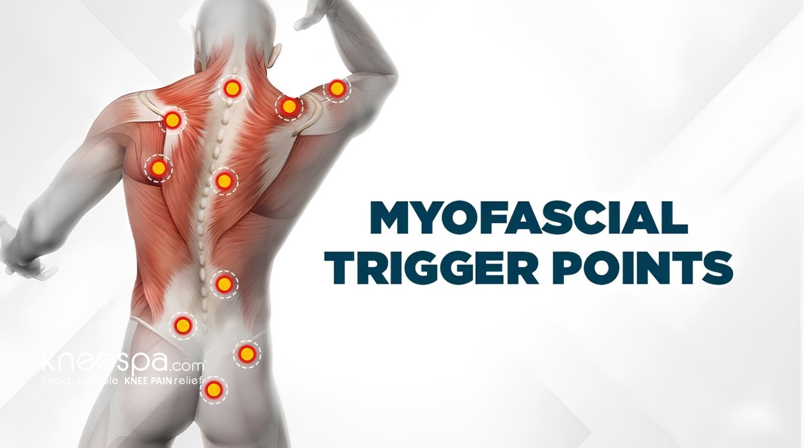 What are Trigger Points?