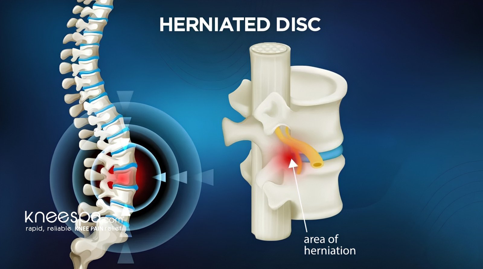 What is a Herniated Disc?