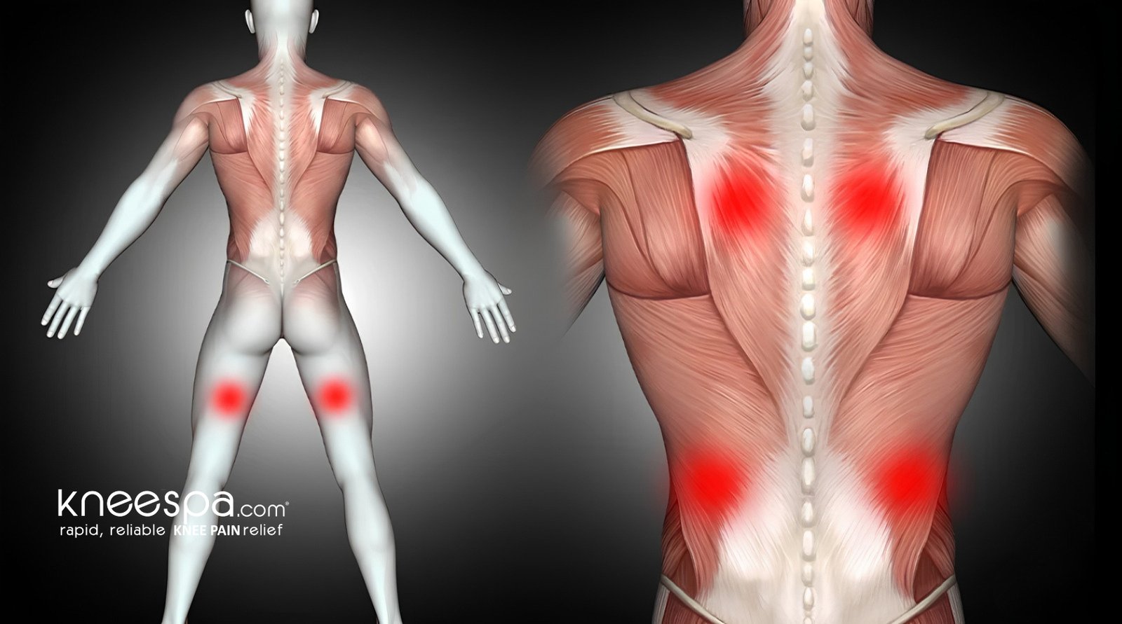 Where Do Trigger Points Form?